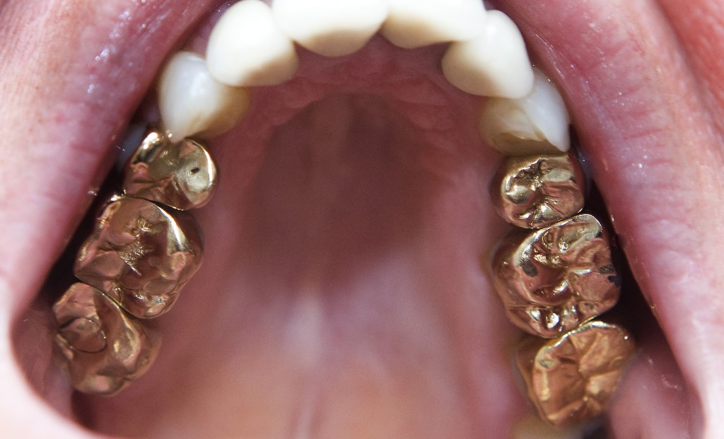 Slaapzaal directory gewoon Wit gebit is hip, vraag naar goud onder tandartsen flink gedaald