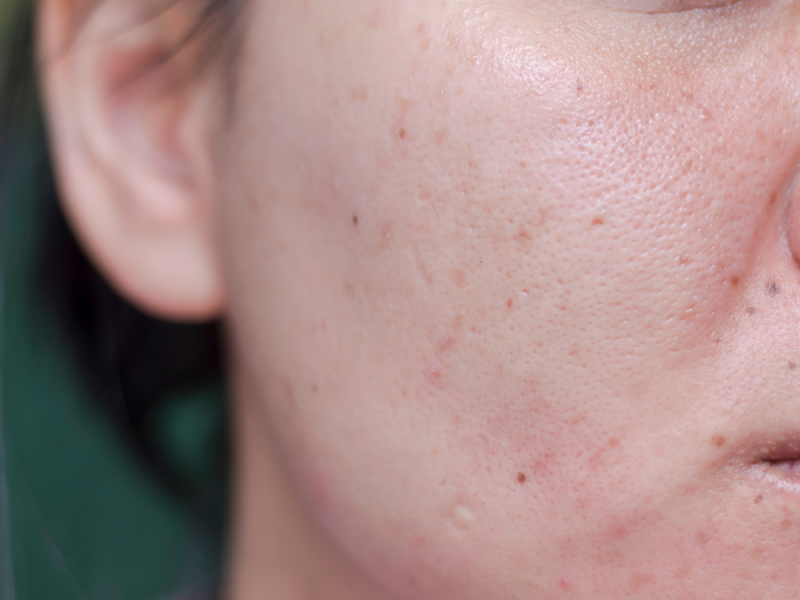 how to get rid of dark acne spots at home