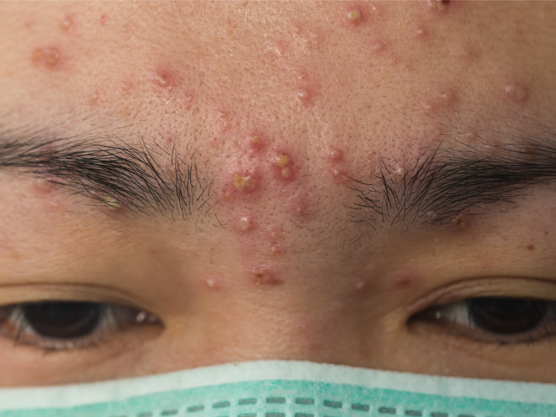 11-skin-bumps-that-look-like-pimples-but-aren-t