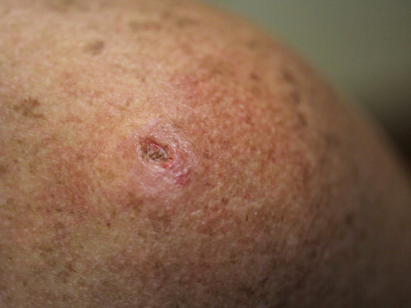 11 Skin Bumps That Look Like Pimples But Arent