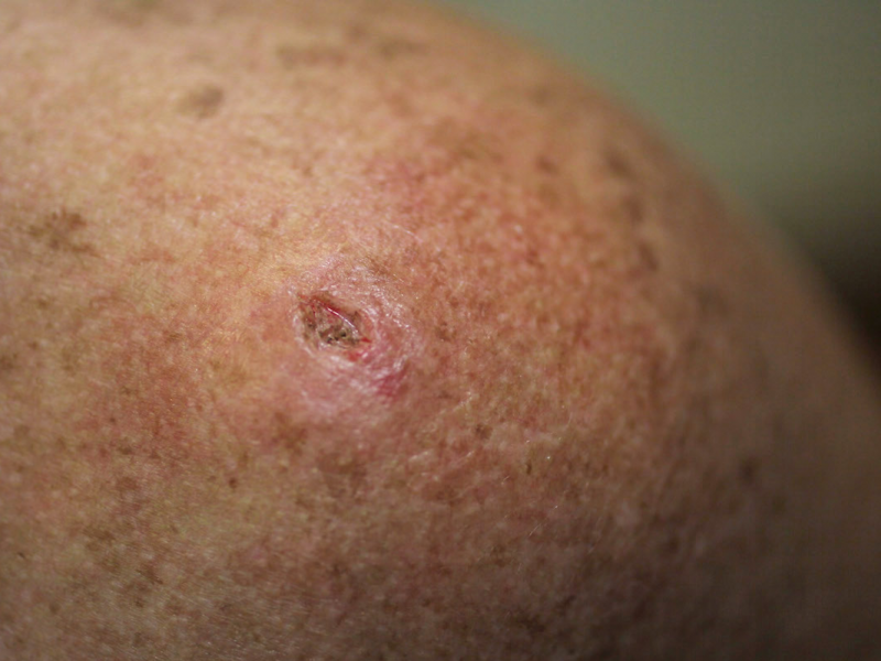 cancer-bumps-on-skin