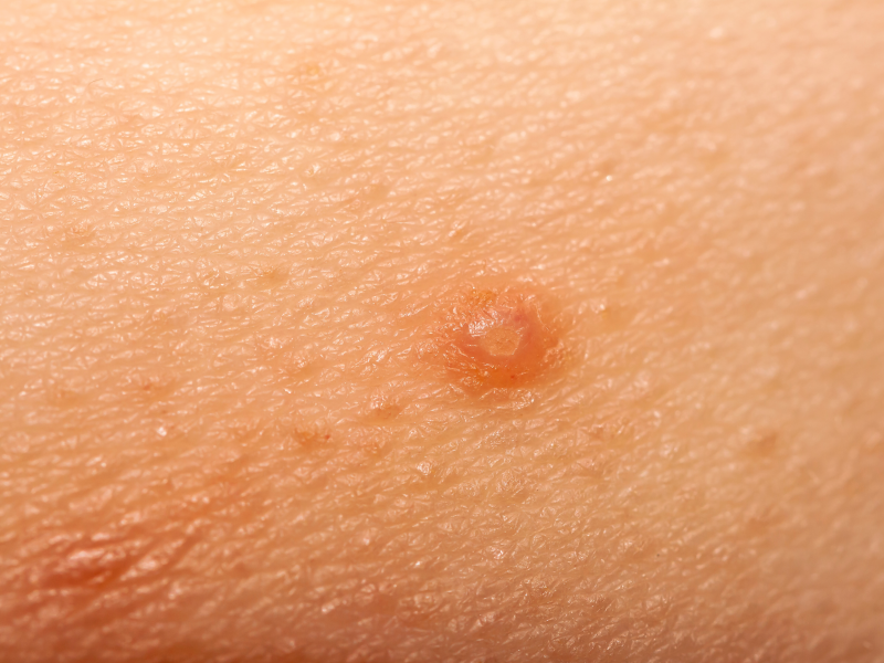 cancer-bumps-on-skin