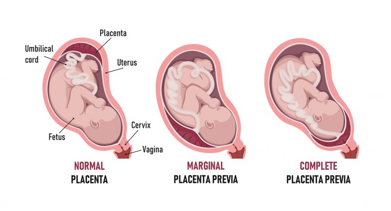 different-placental-locations-during-pregnancy-major-placenta-previa