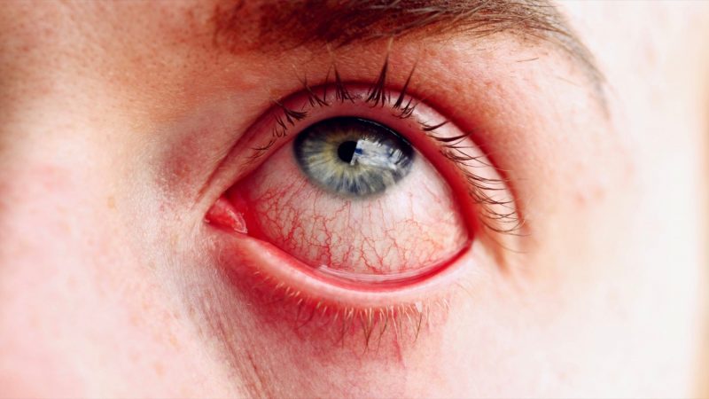 What Is Causing So Much Pink Eye?