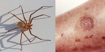 How to treat a spider bite and when to seek medical attention