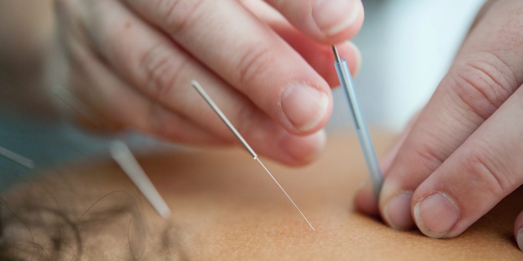 acupunctuur alternatieve geneeswijzen.