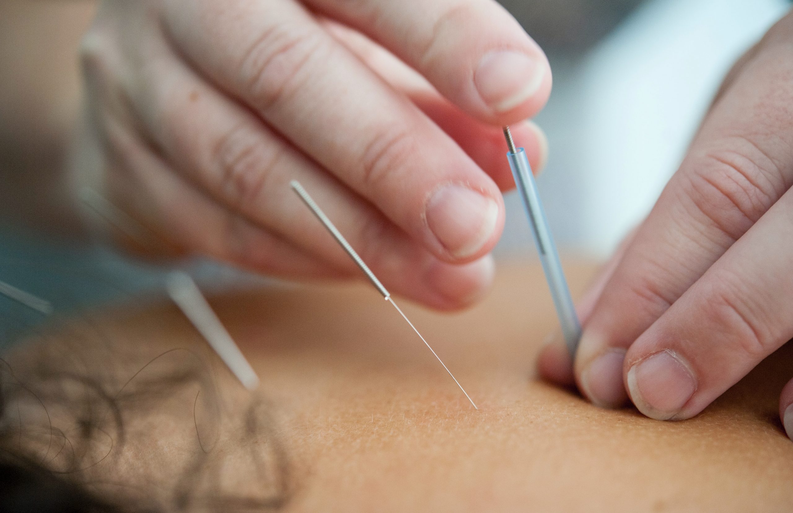 acupunctuur alternatieve geneeswijzen.