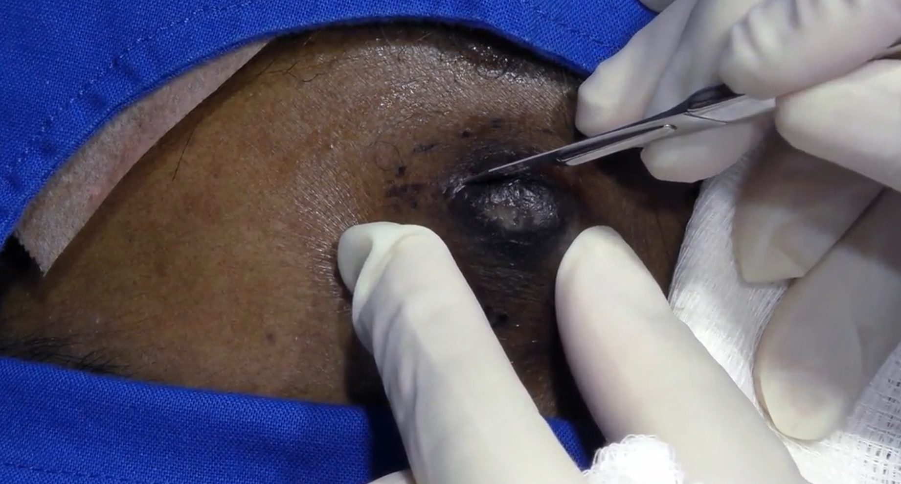 dr pimple popper