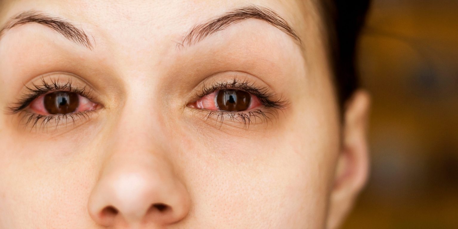 Do you have viral or bacterial pink eye? How to tell the difference and