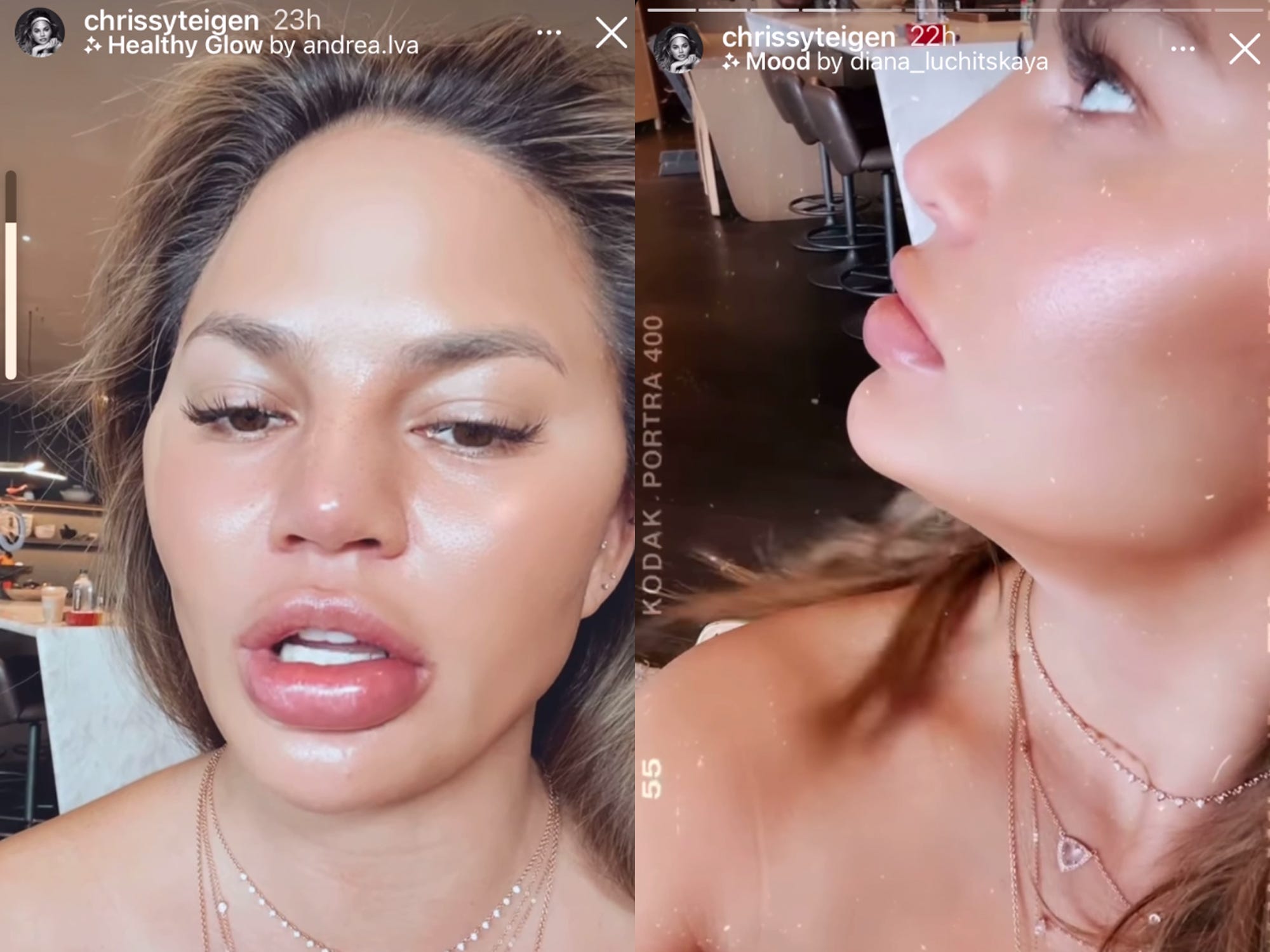 teigen lip