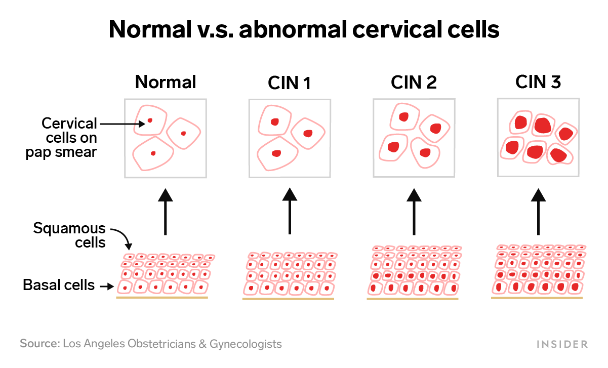 Why an abnormal Pap smear doesn't always mean you have cancer