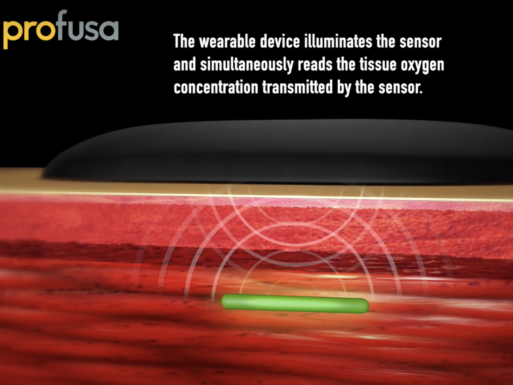 Profusa Lumee DARPA sensor