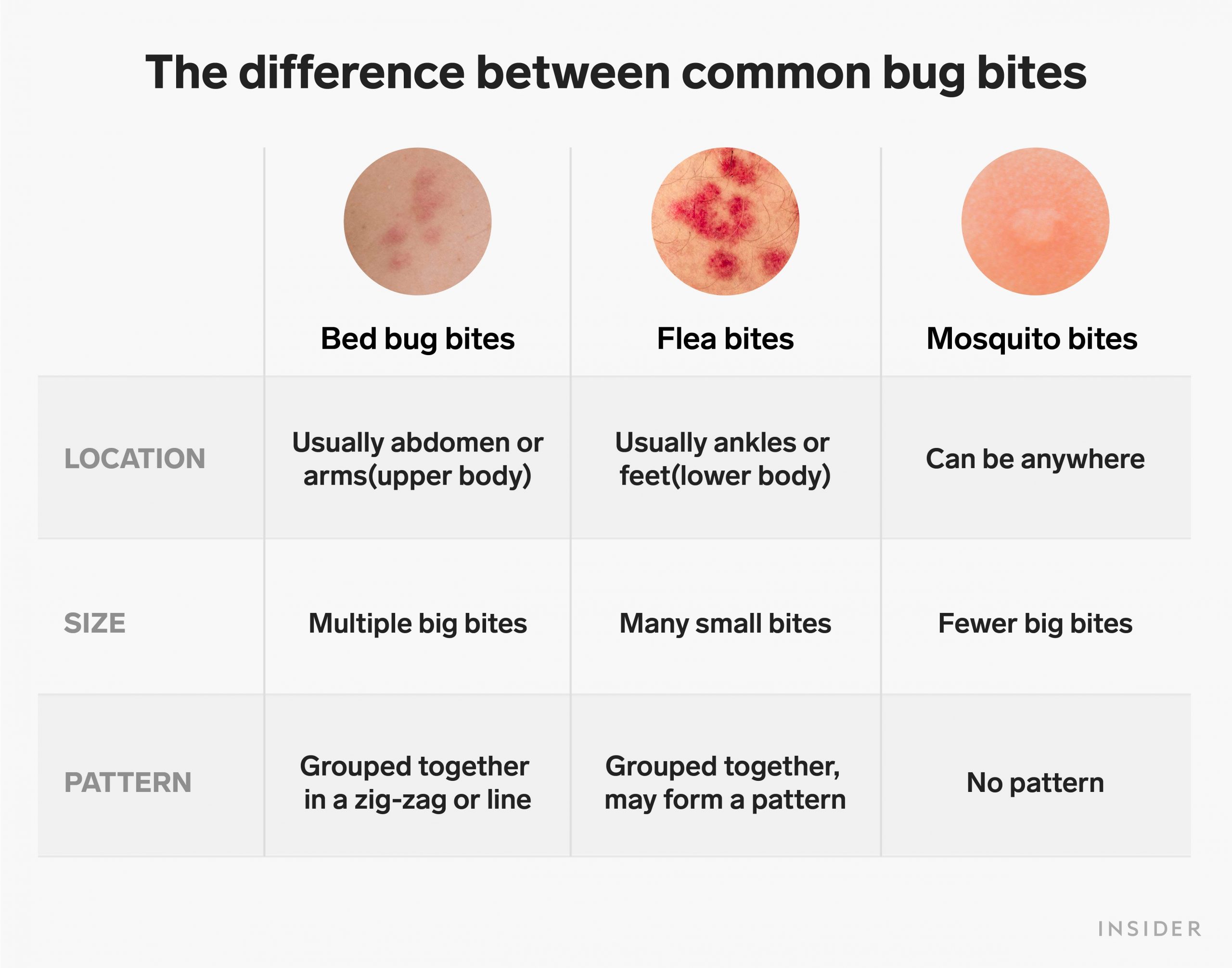 How to treat itchy bug bites