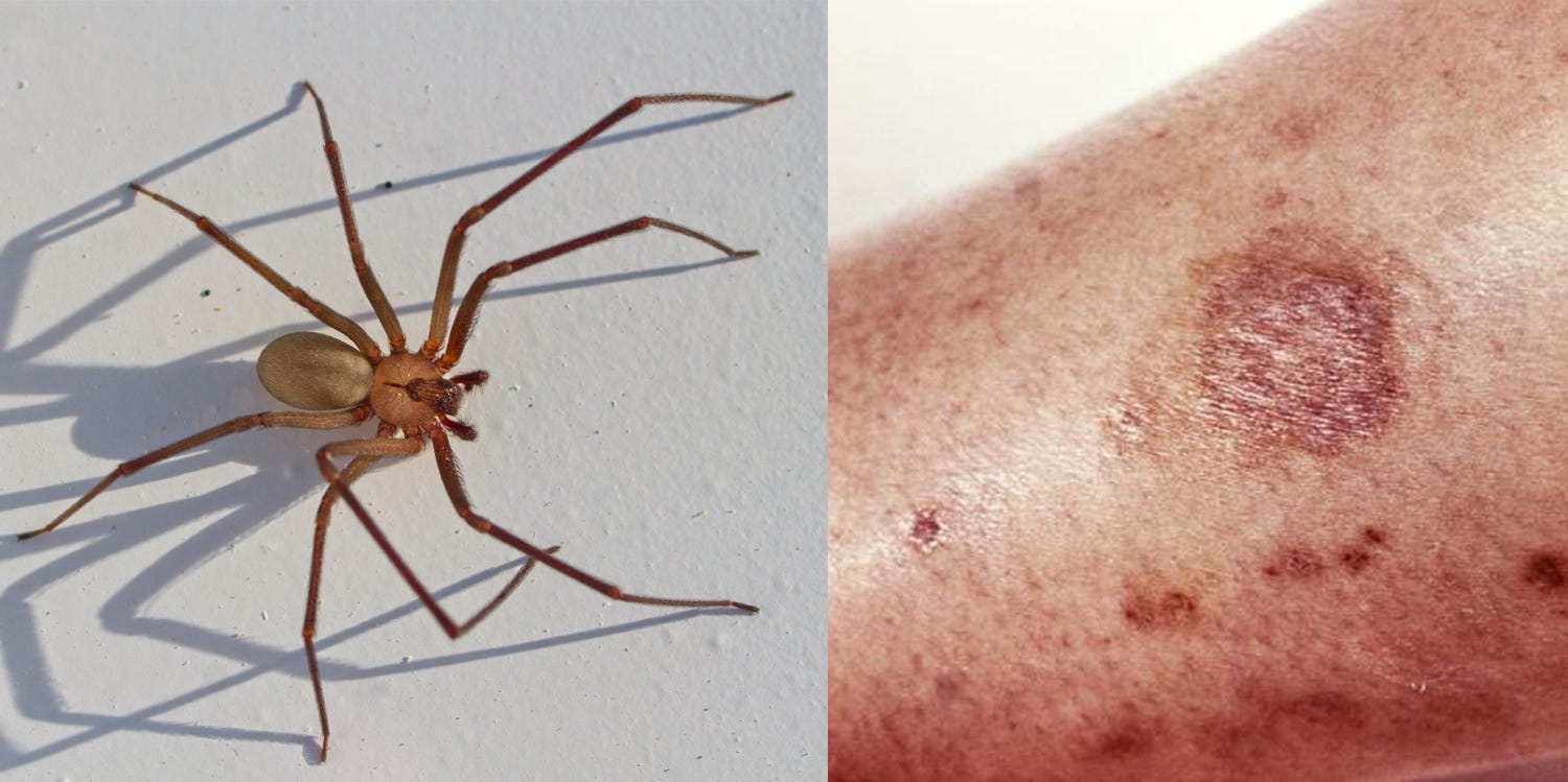australian spider bites