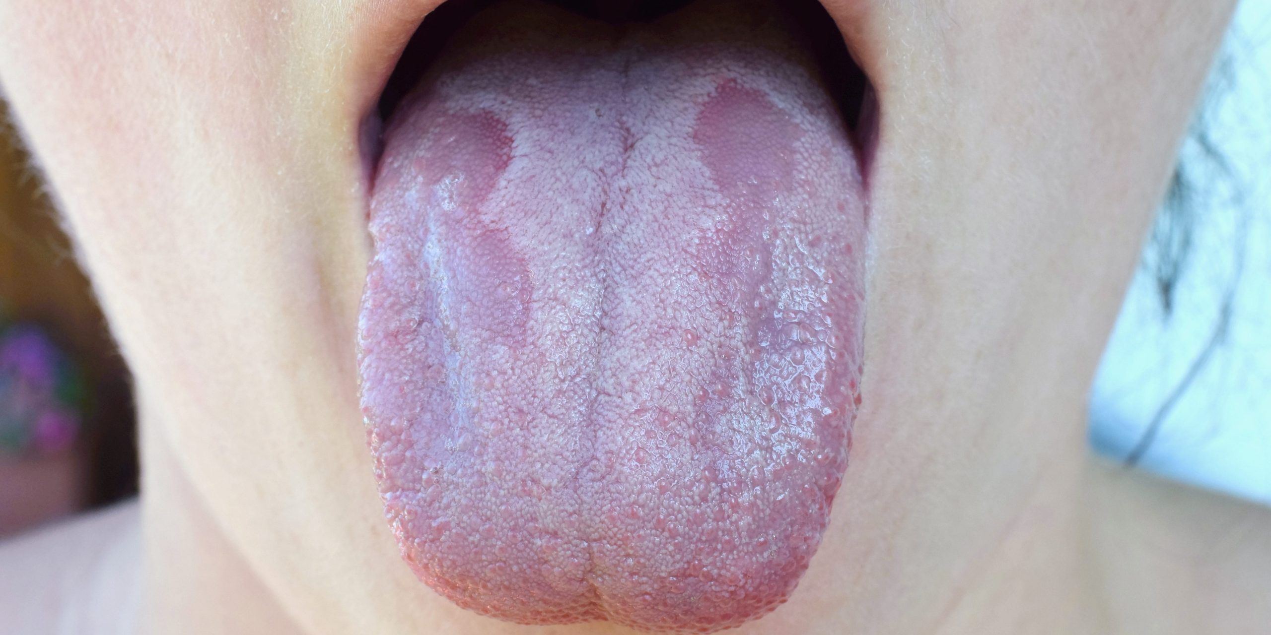 white tongue