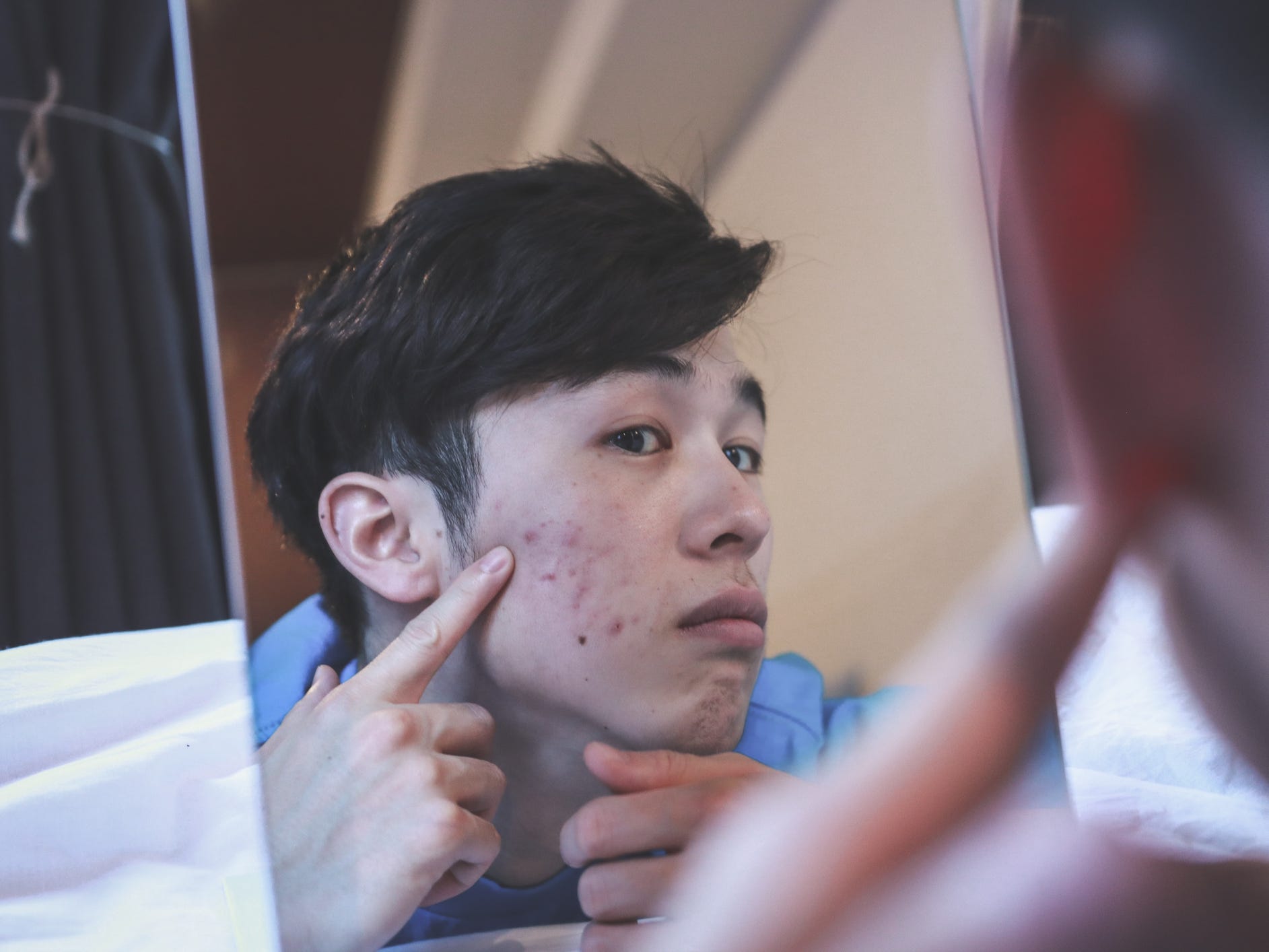 person with acne