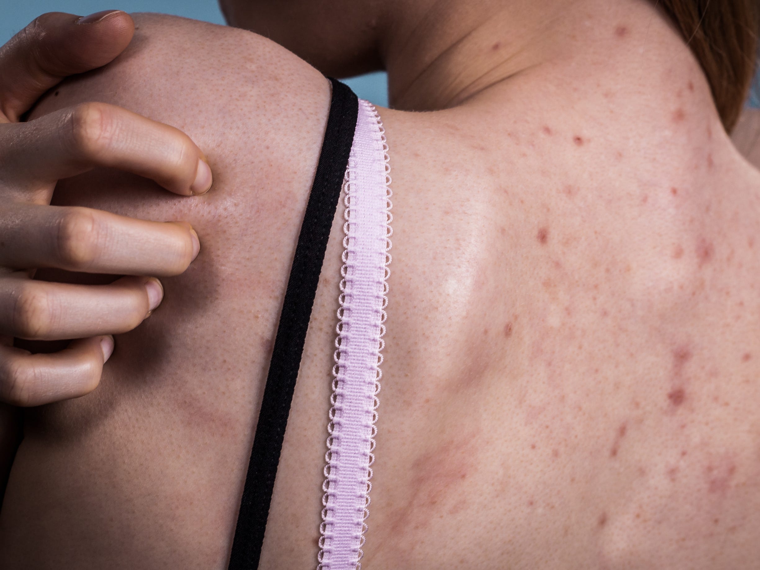 Back acne