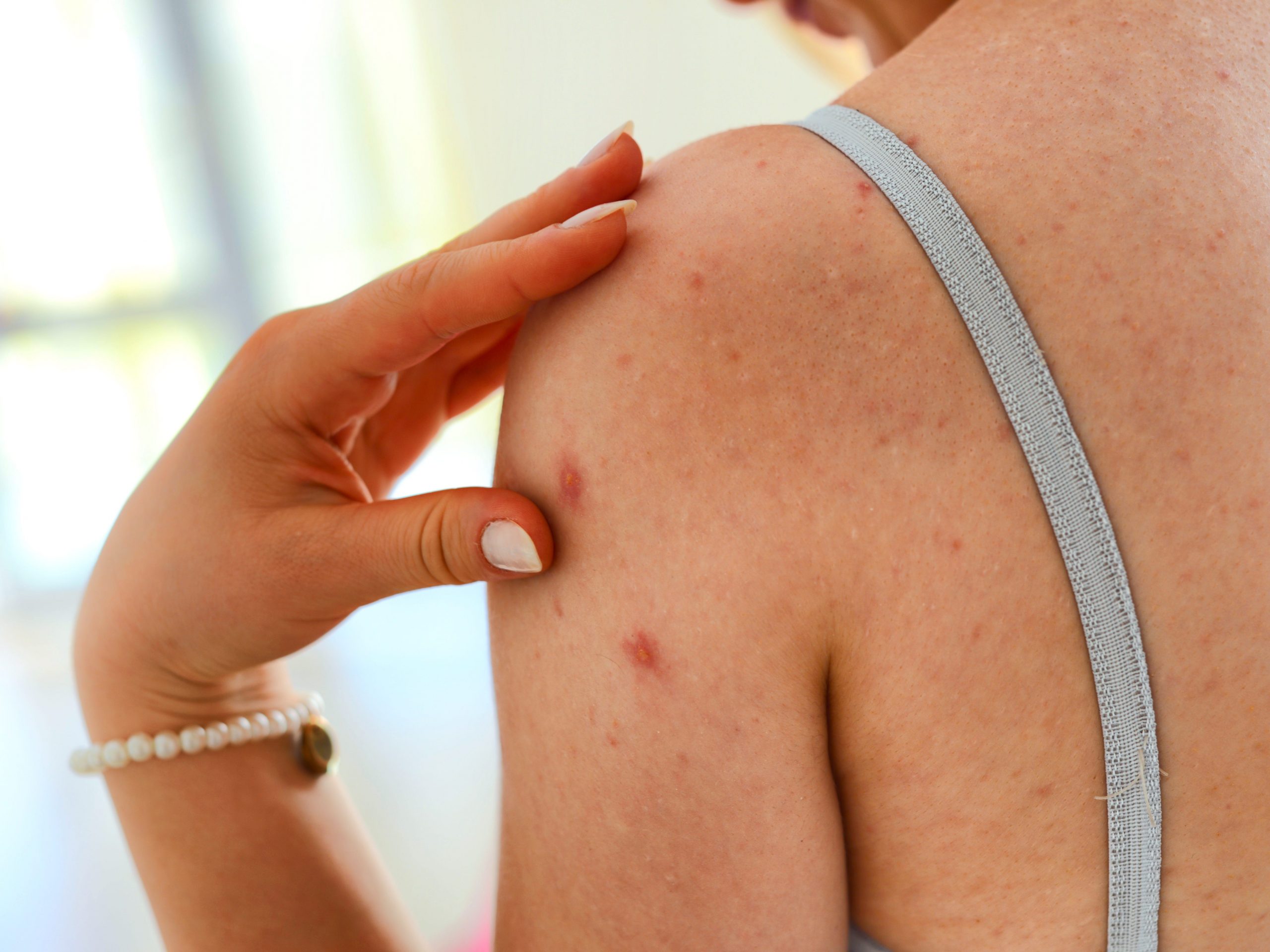 back acne
