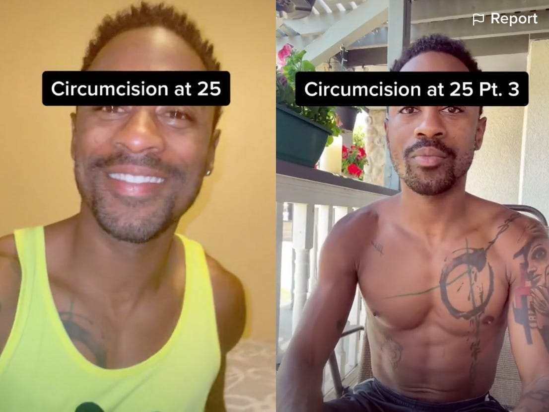Circumcision at 25