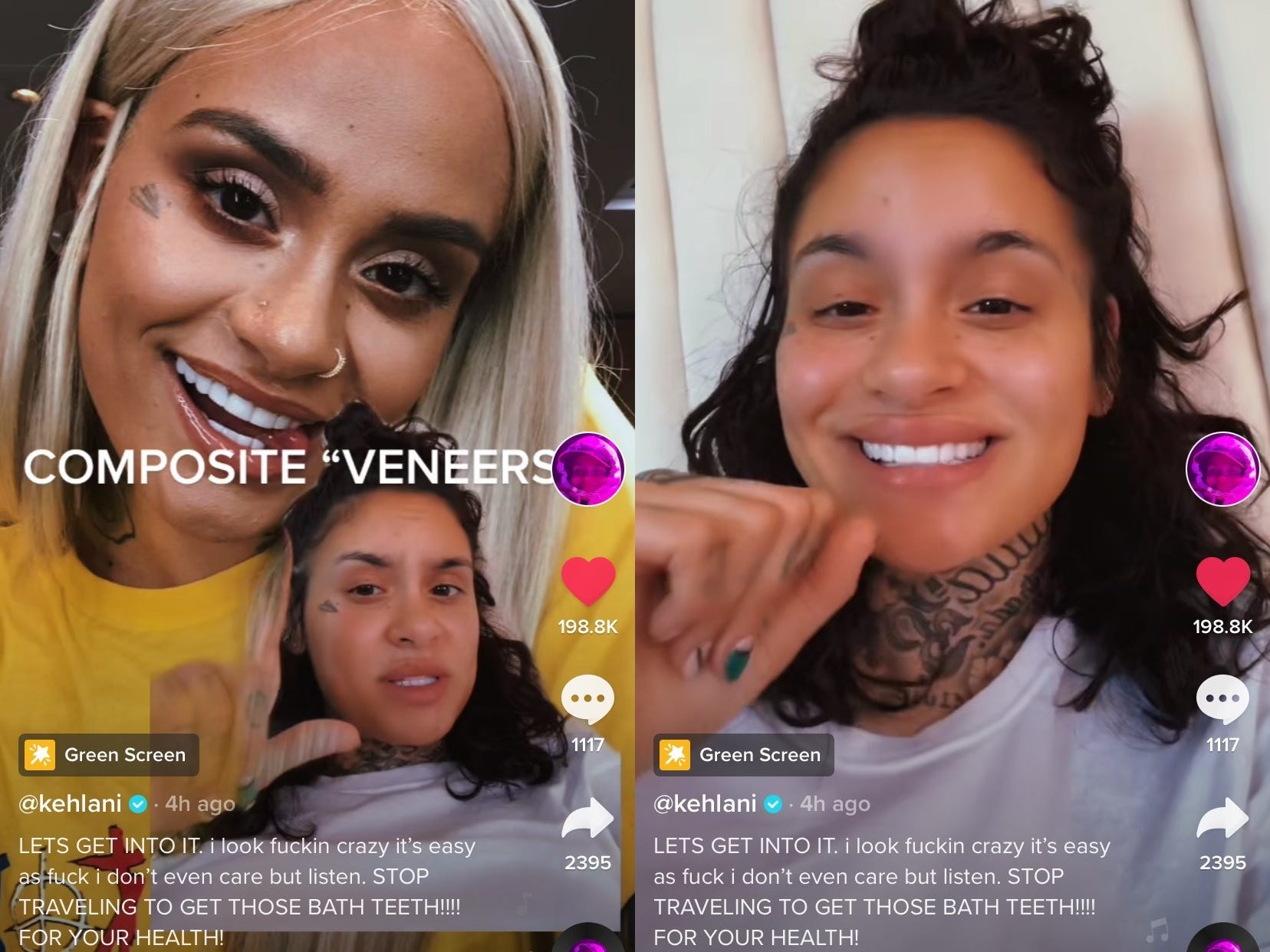 Kehlani Composite veneers