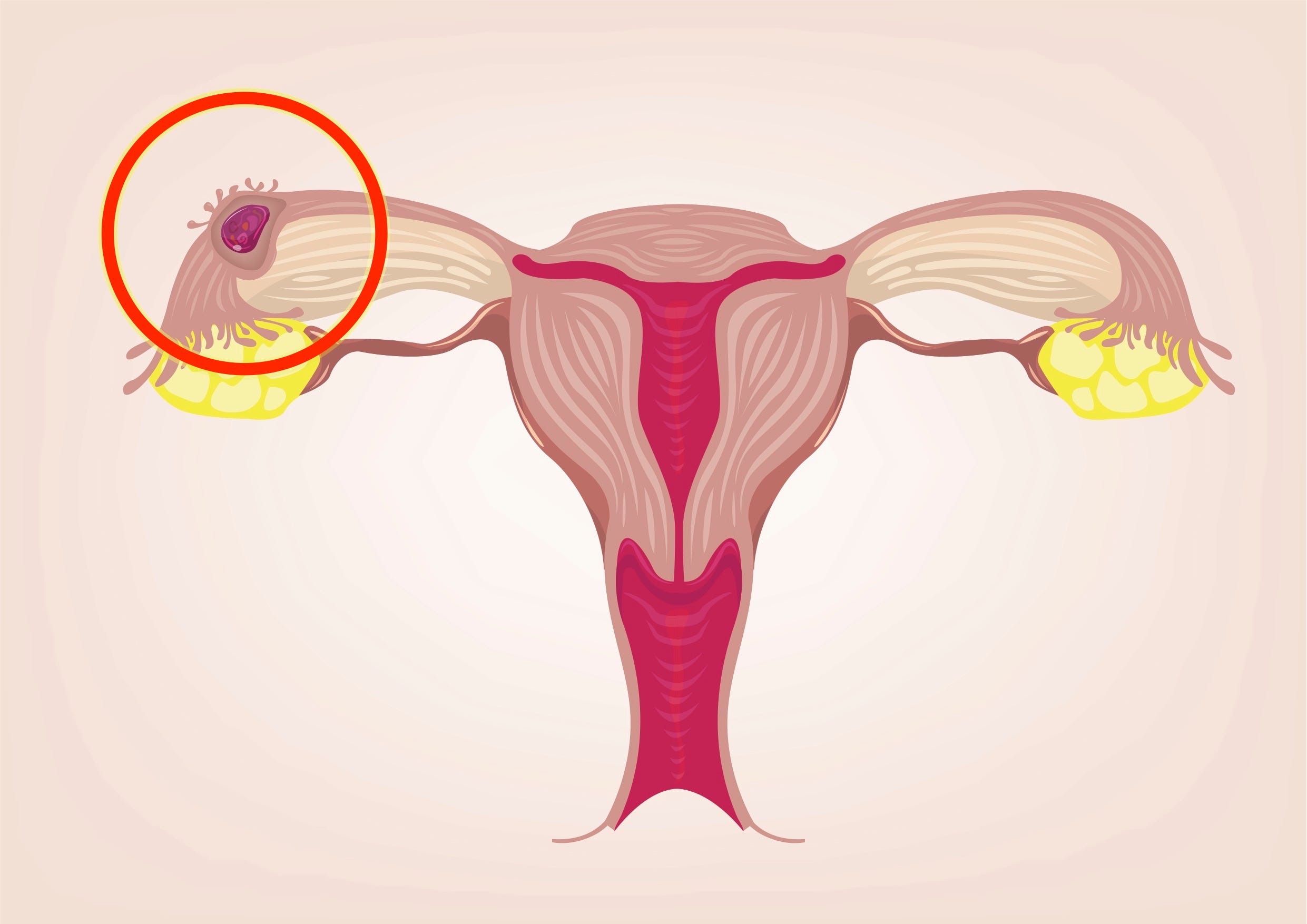 why-ectopic-pregnancies-are-so-dangerous-and-how-to-tell-when-you-have-one