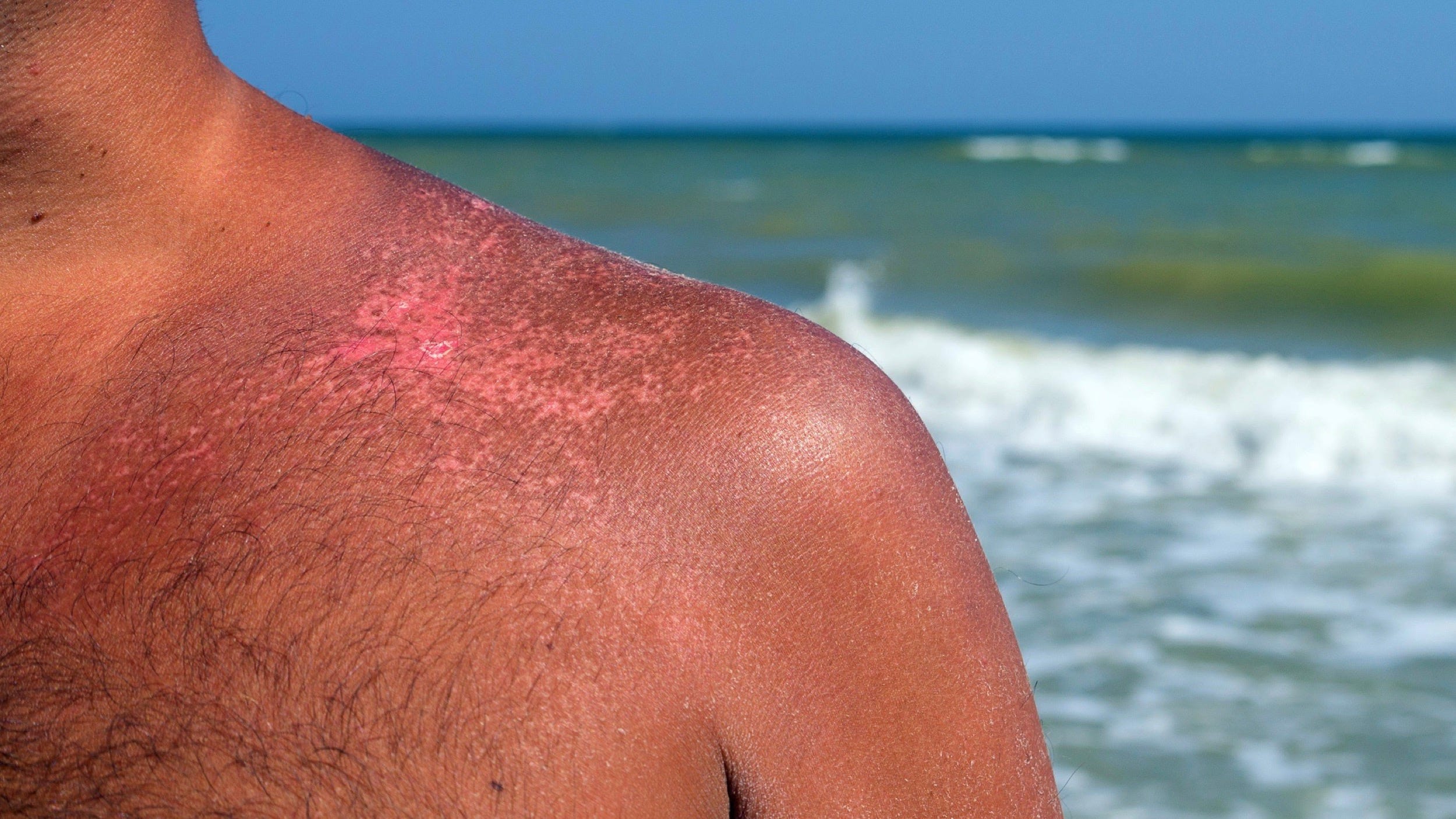 how to get rid of sunburn blisters