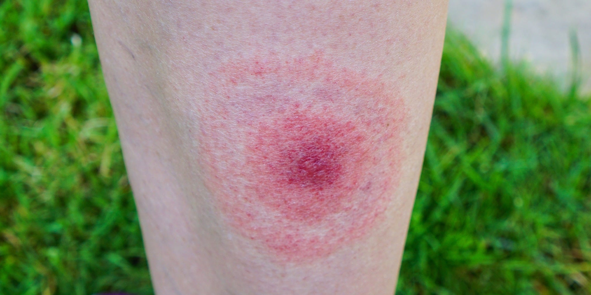 lyme disease