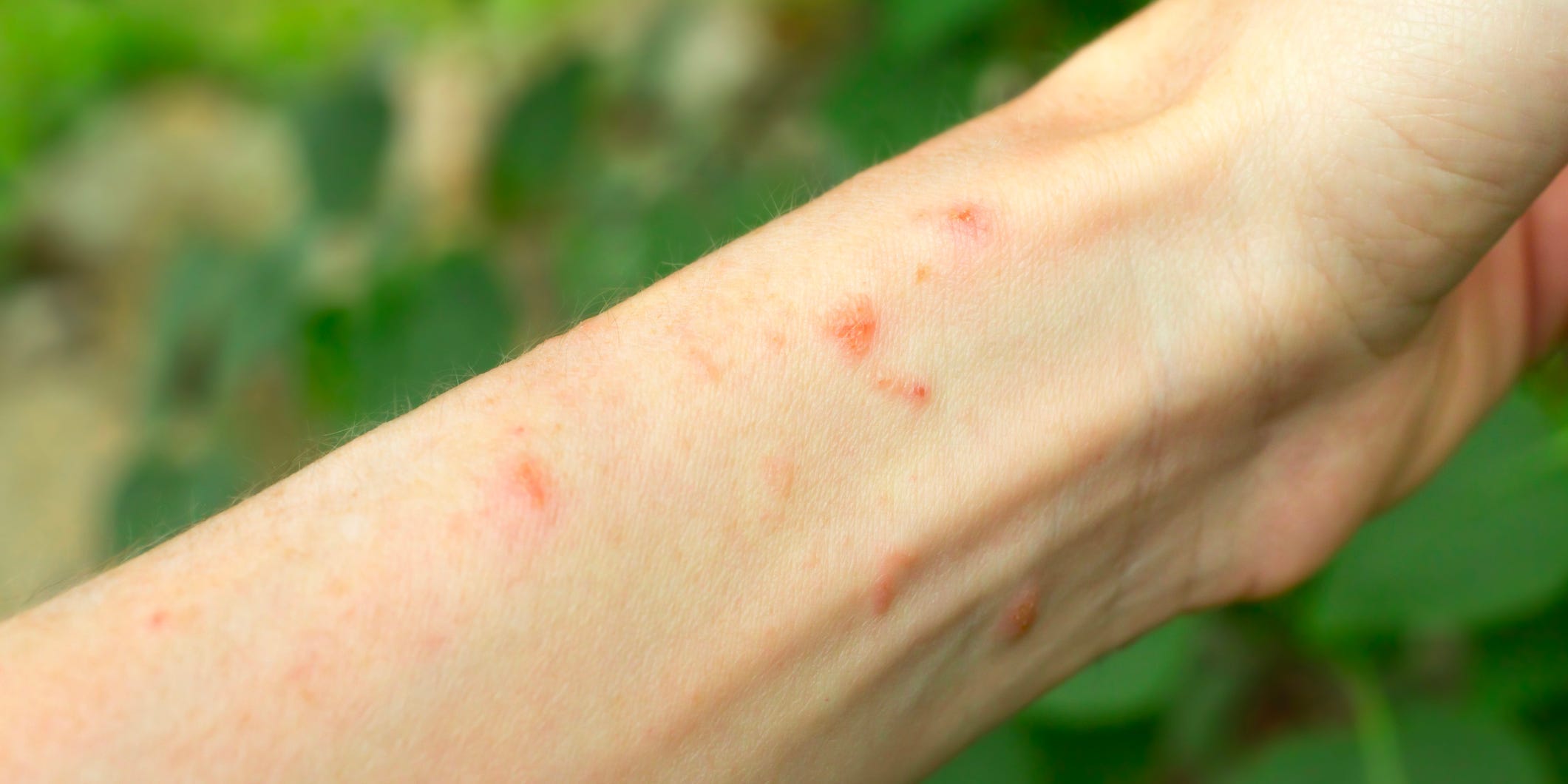 poison ivy rash