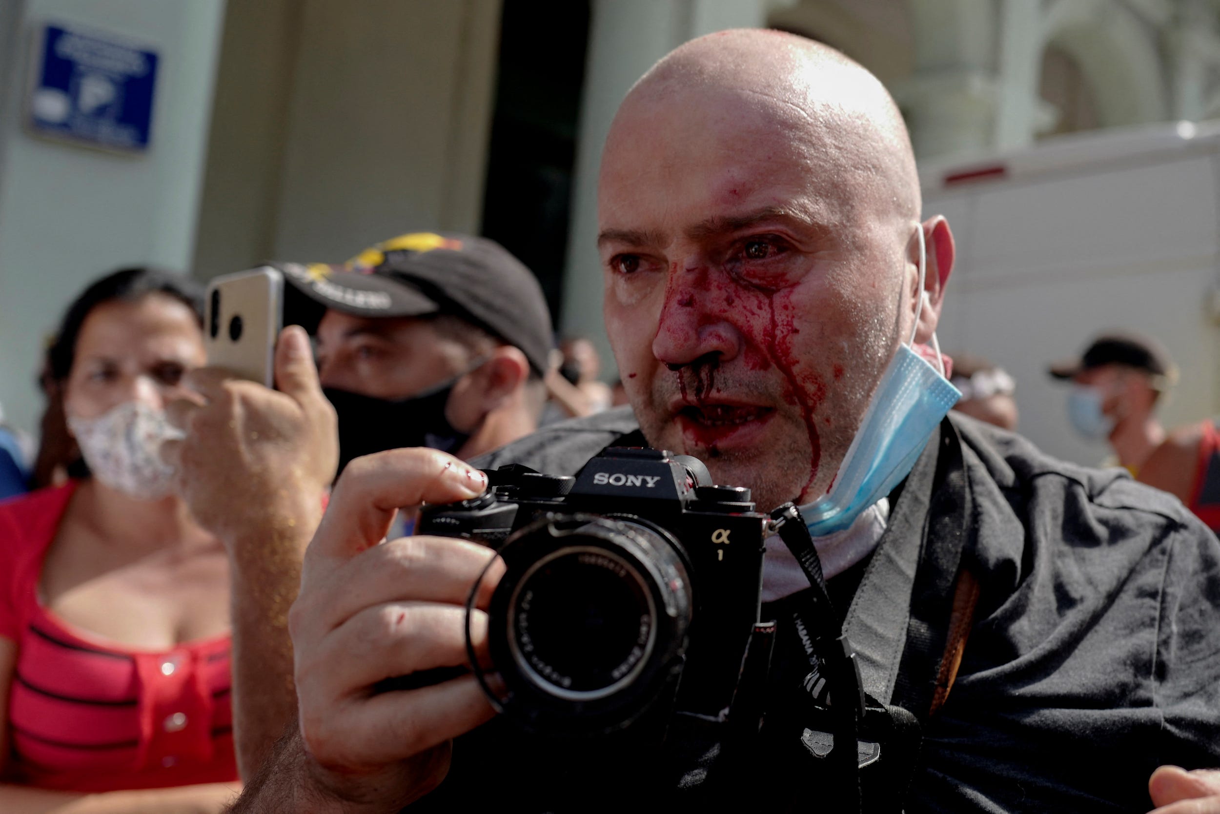 AP photographer, Spanish Ramon Espinosa, is seen with injuries in his face while covering a demonstration against Cuban President Miguel Diaz-Canel in Havana, on July 11, 2021.