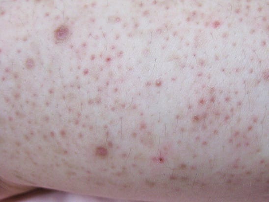 keratosis