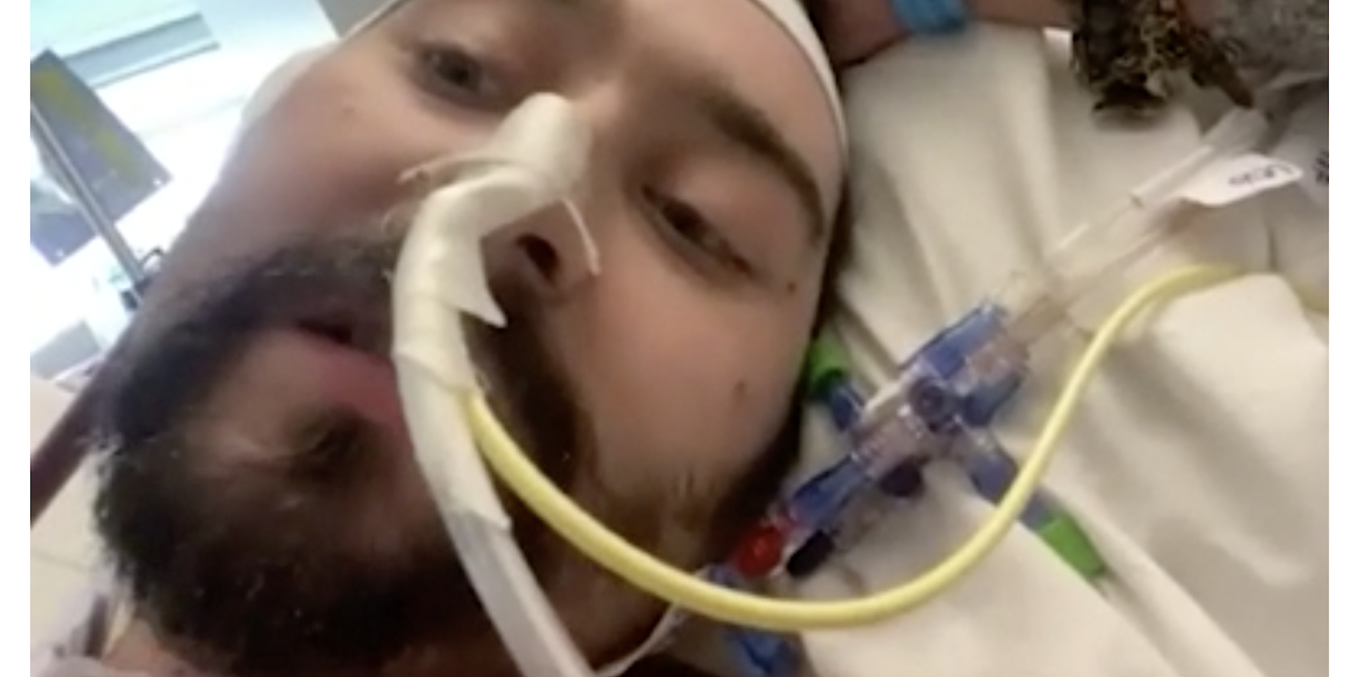 A screenshot from a video of Blake Bargatze, where he has a tube in his nose.
