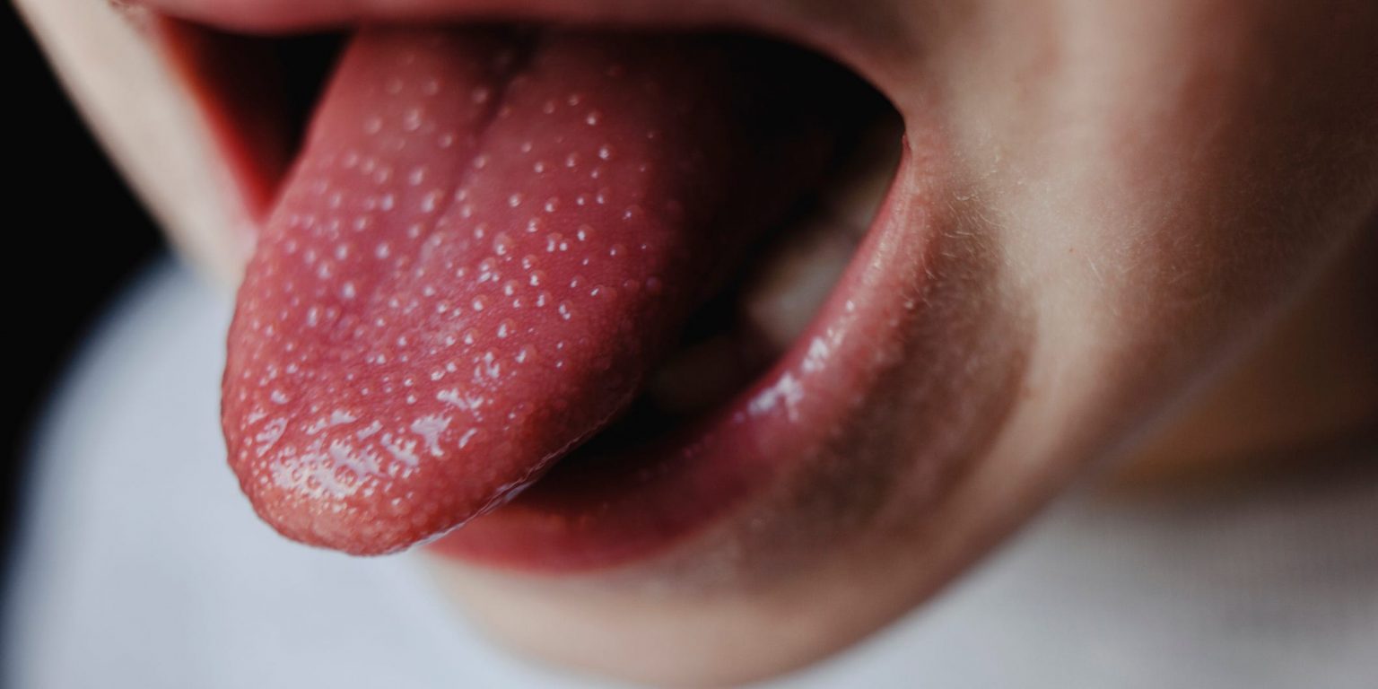 What Those Bumps On Your Tongue Mean And How To Get Rid Of Them 1628