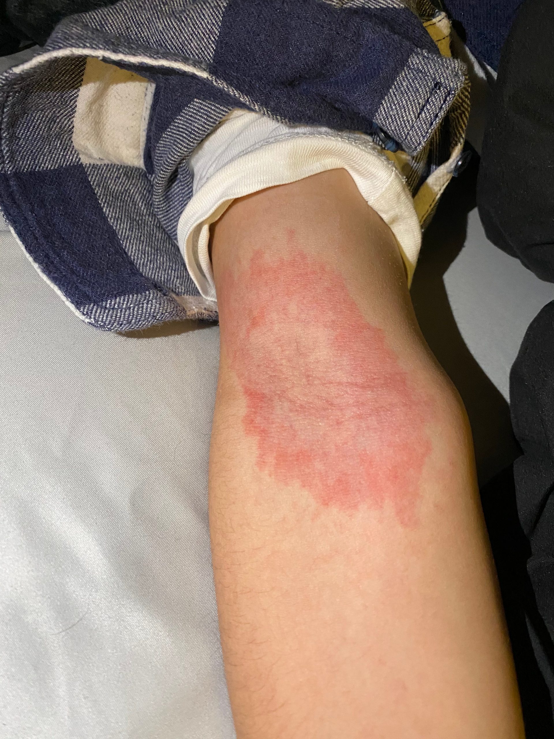 a red rash about the size of a coffee cup inside abie's arm