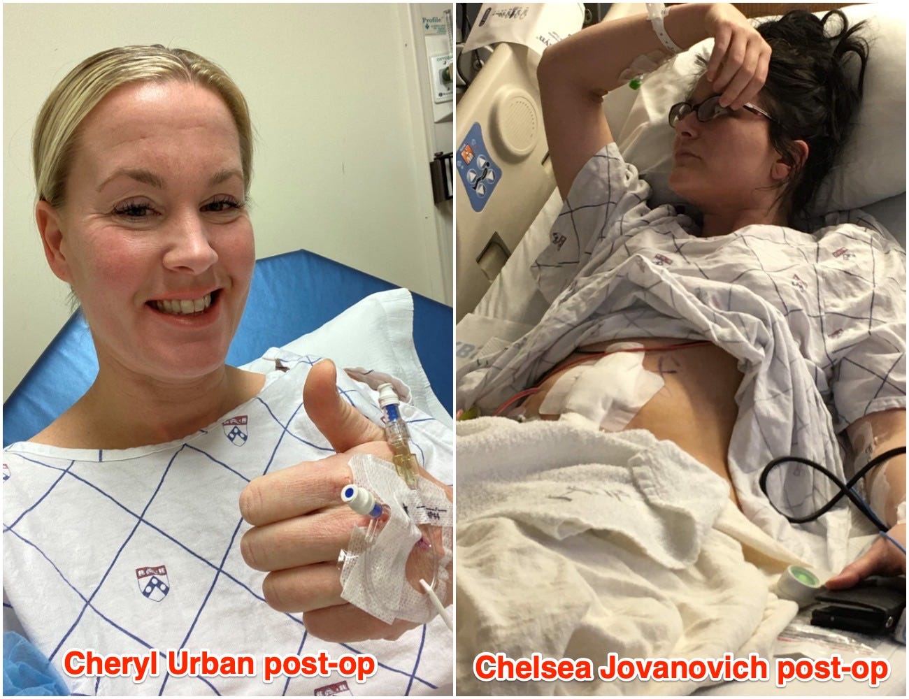 A side by side of Chelsea Jovanovich (right) and Cheryl Urban (left) after their operations in 2020.