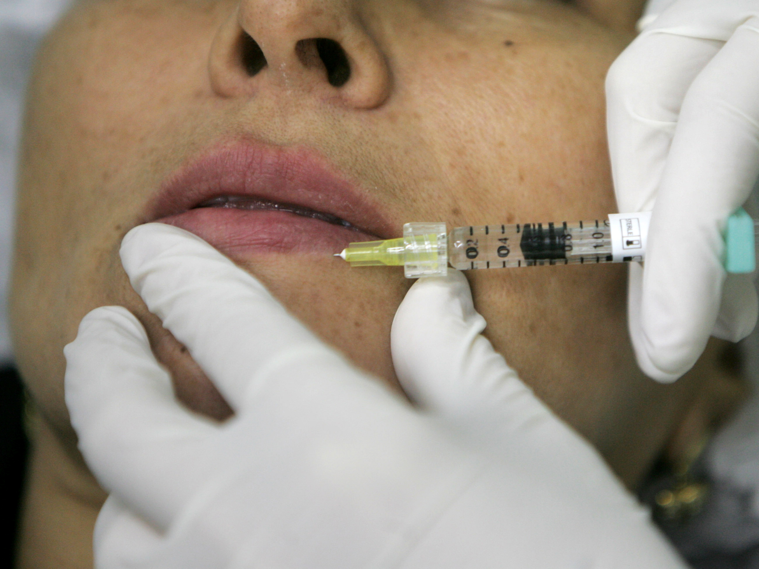 lip filler injection