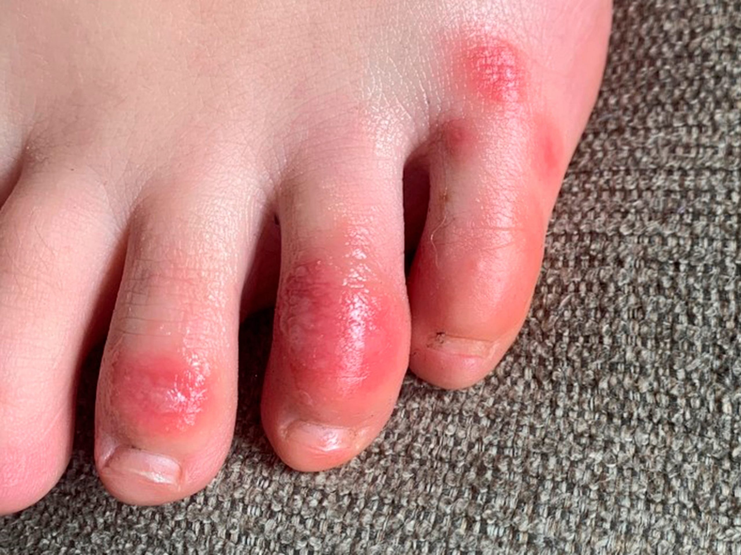 This April 3, 2020 photo provided by Northwestern University shows discoloration on a teenage patient's toes at the onset of the condition informally called "COVID toes." The red, sore and sometimes itchy swellings on toes look like chilblains, something doctors normally see on the feet and hands of people who’ve spent a long time outdoors in the cold. (Courtesy of Dr. Amy Paller/Northwestern University via AP)