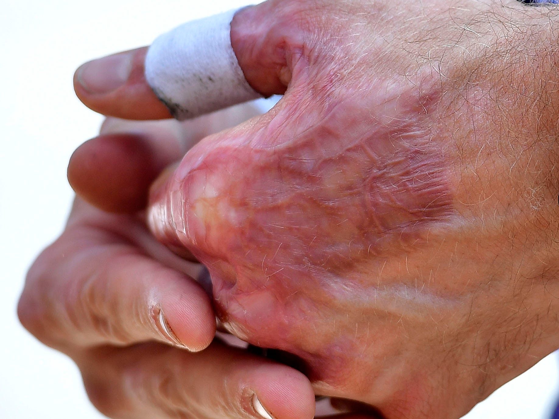 Burn scars are seen on the hands of Indycar driver Romain Grosjean.