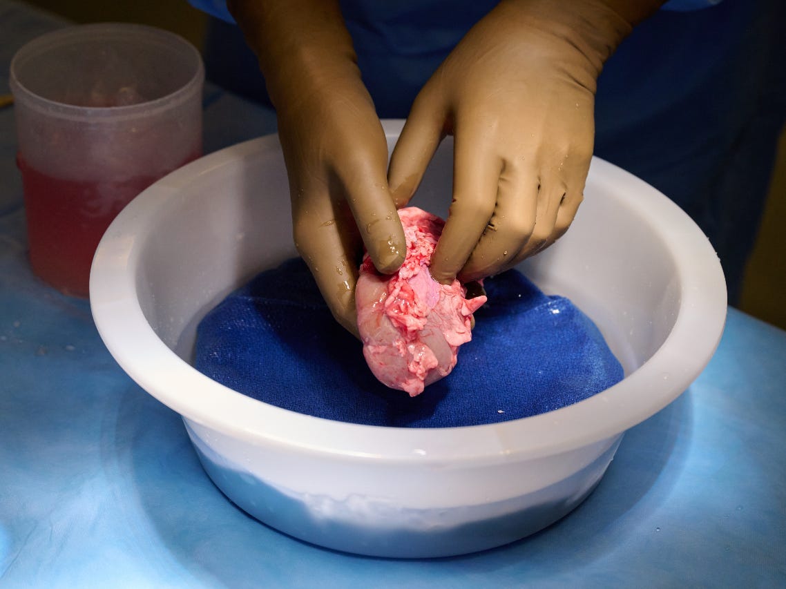 A pig kidney being held in gloved hands in preparation for surgical transplant.