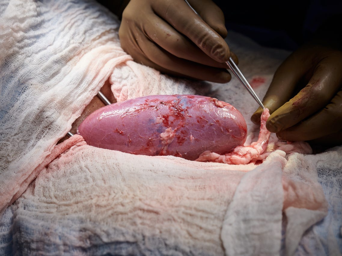 A pig kidney surgically attached to the blood vessels of a human patient's leg