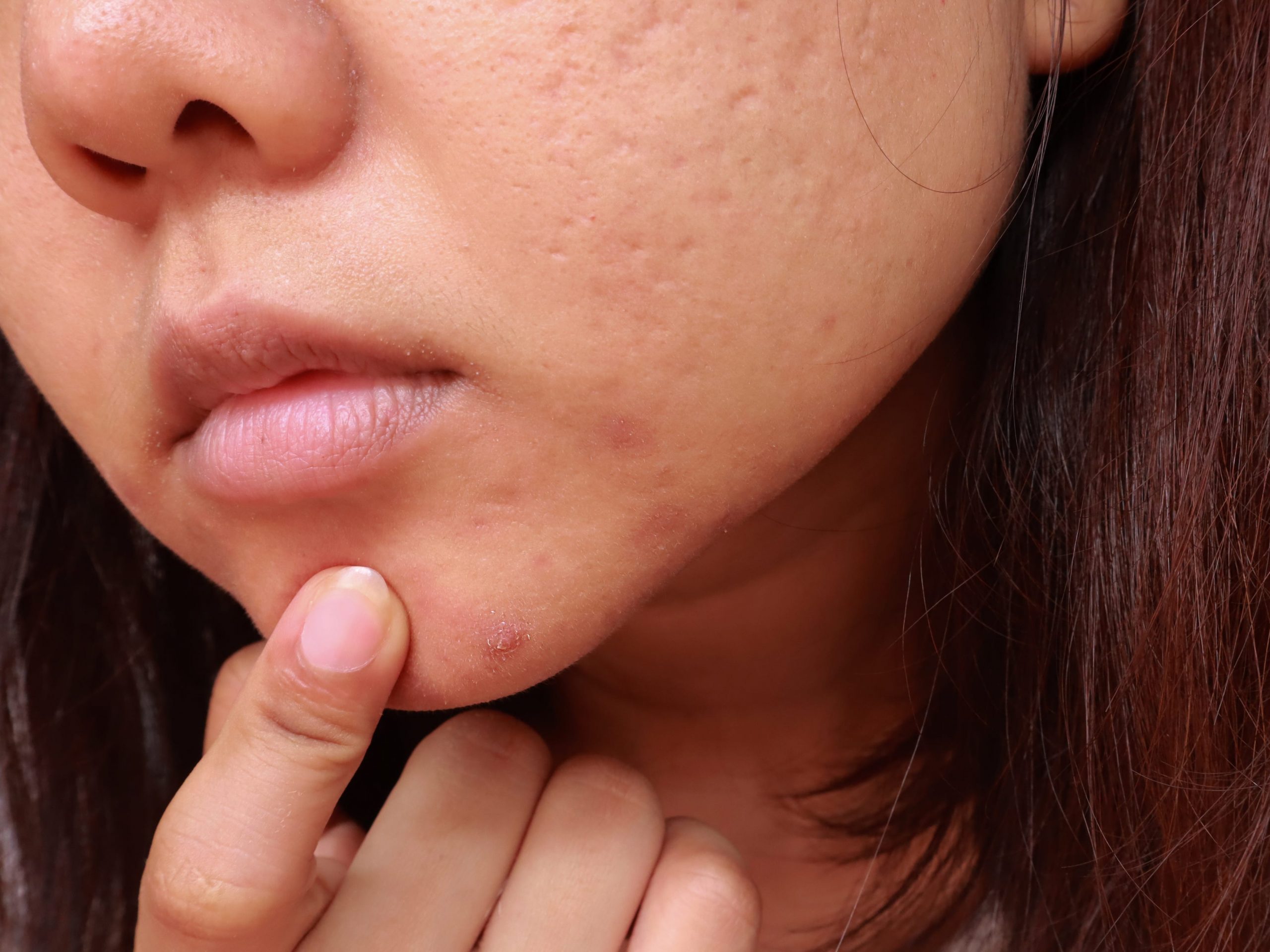 you shouldn't your pimple, and when it's OK, according to dermatologists
