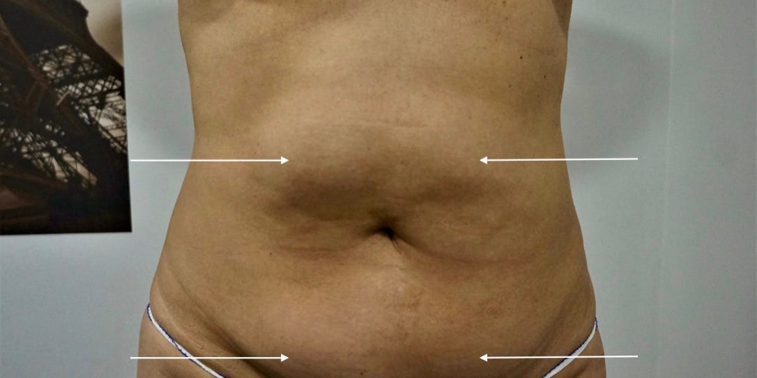 A person's naked belly is seen facing ahead with arrow pointing to above and below the belly button.