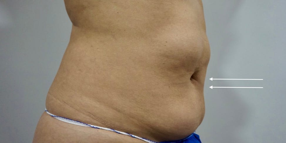 A person's naked belly is seen in profile with arrow pointing to the belly button.