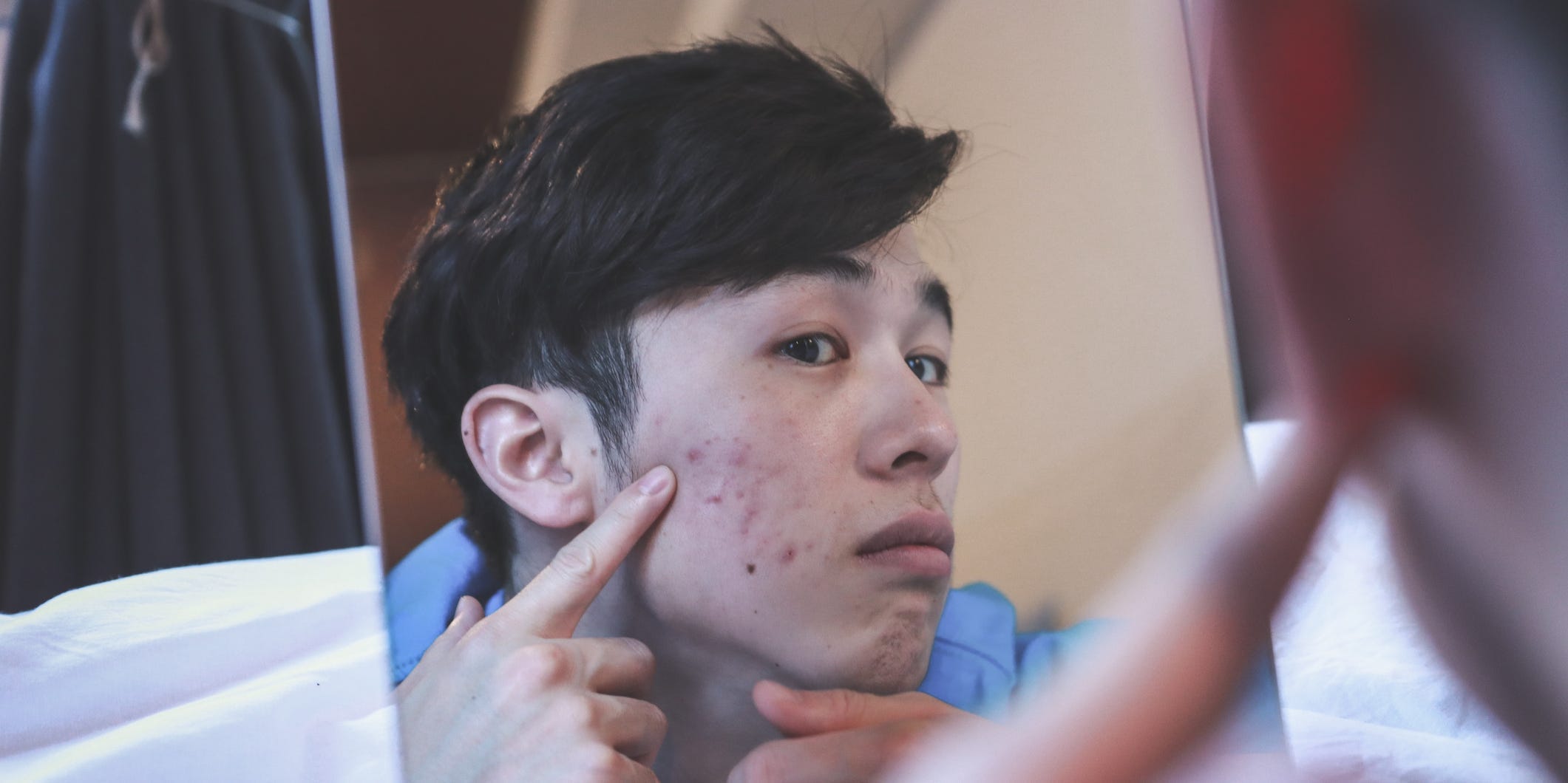 person with acne