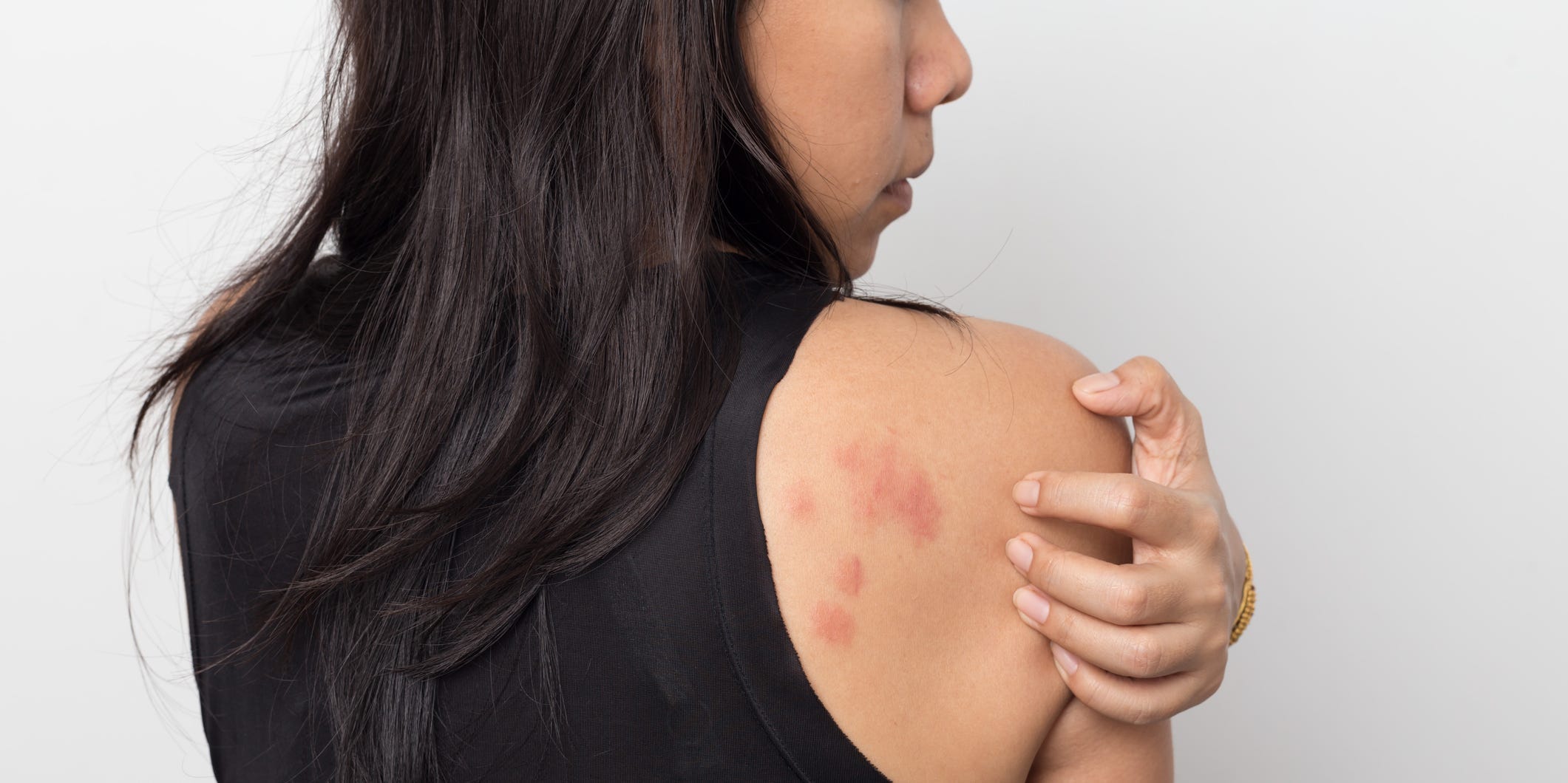 stress rash and hives on woman's back