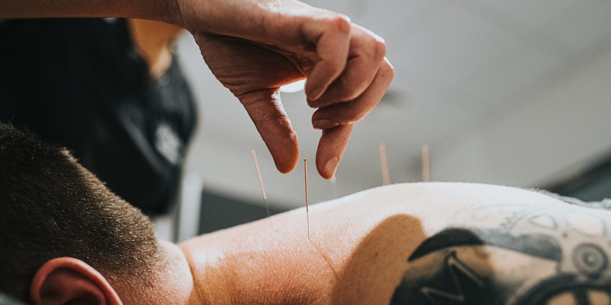 A man lays facedown as an acupuncturist places an acupuncture needle on his back.