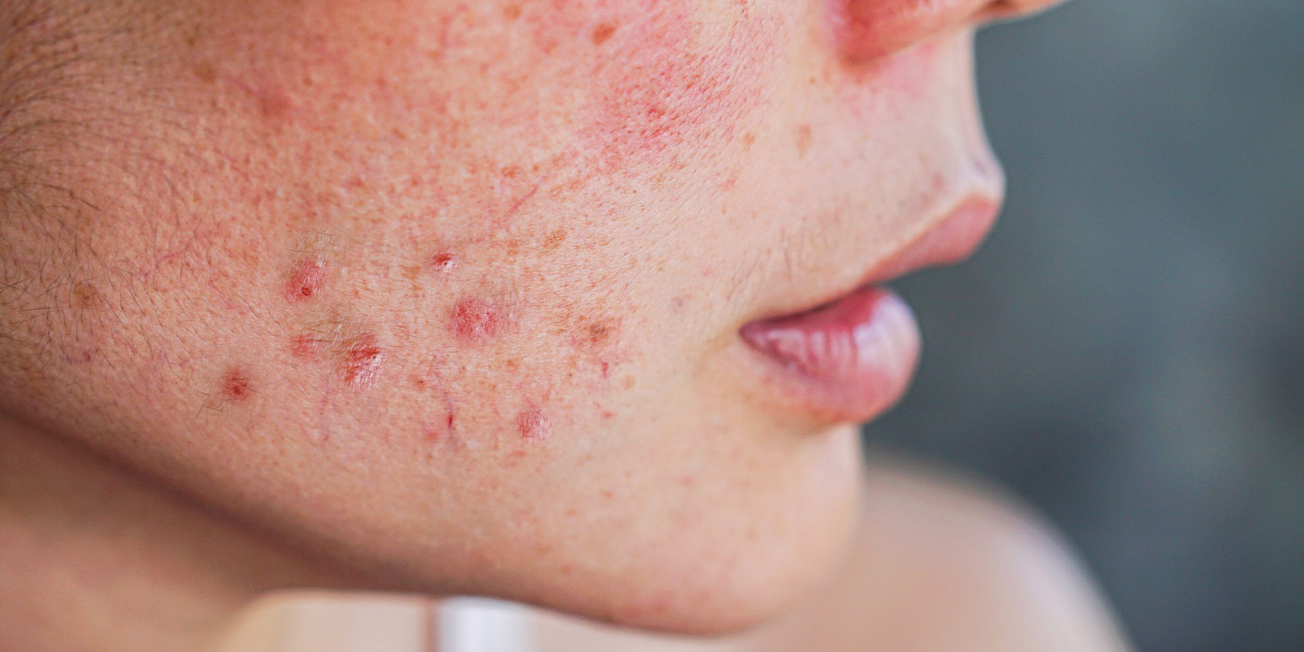 A close-up photo of acne on a person's cheek.