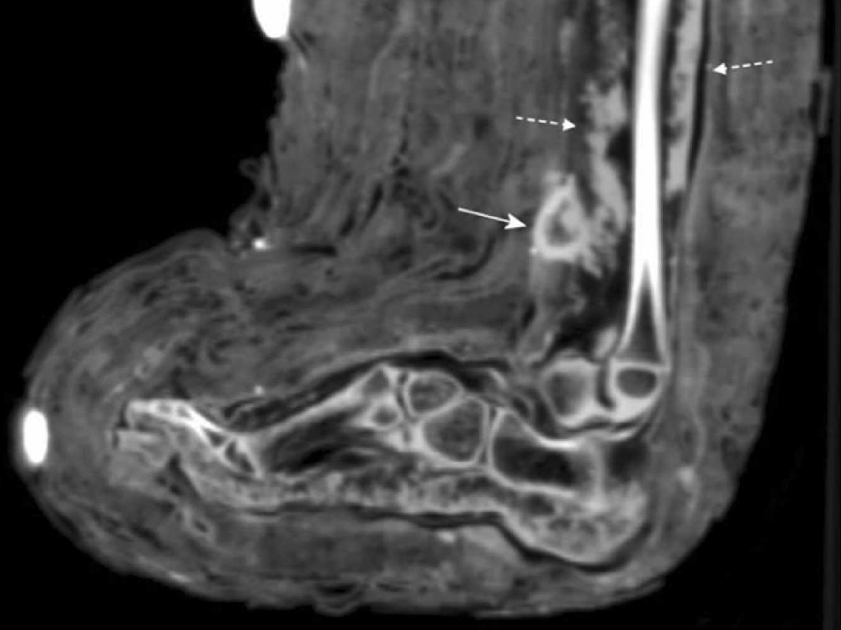 A side view of a scan of the mummy's foot, with arrows pointing to bandages and areas of infection.