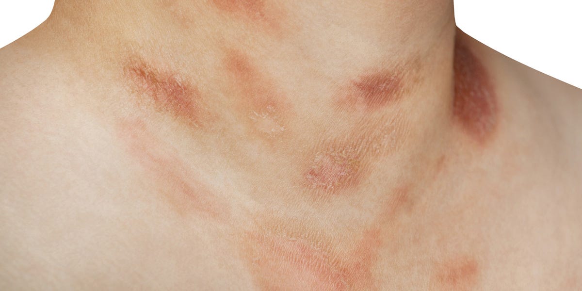 If You Have An Itchy Rash That Resembles A Christmas Tree You May Have
