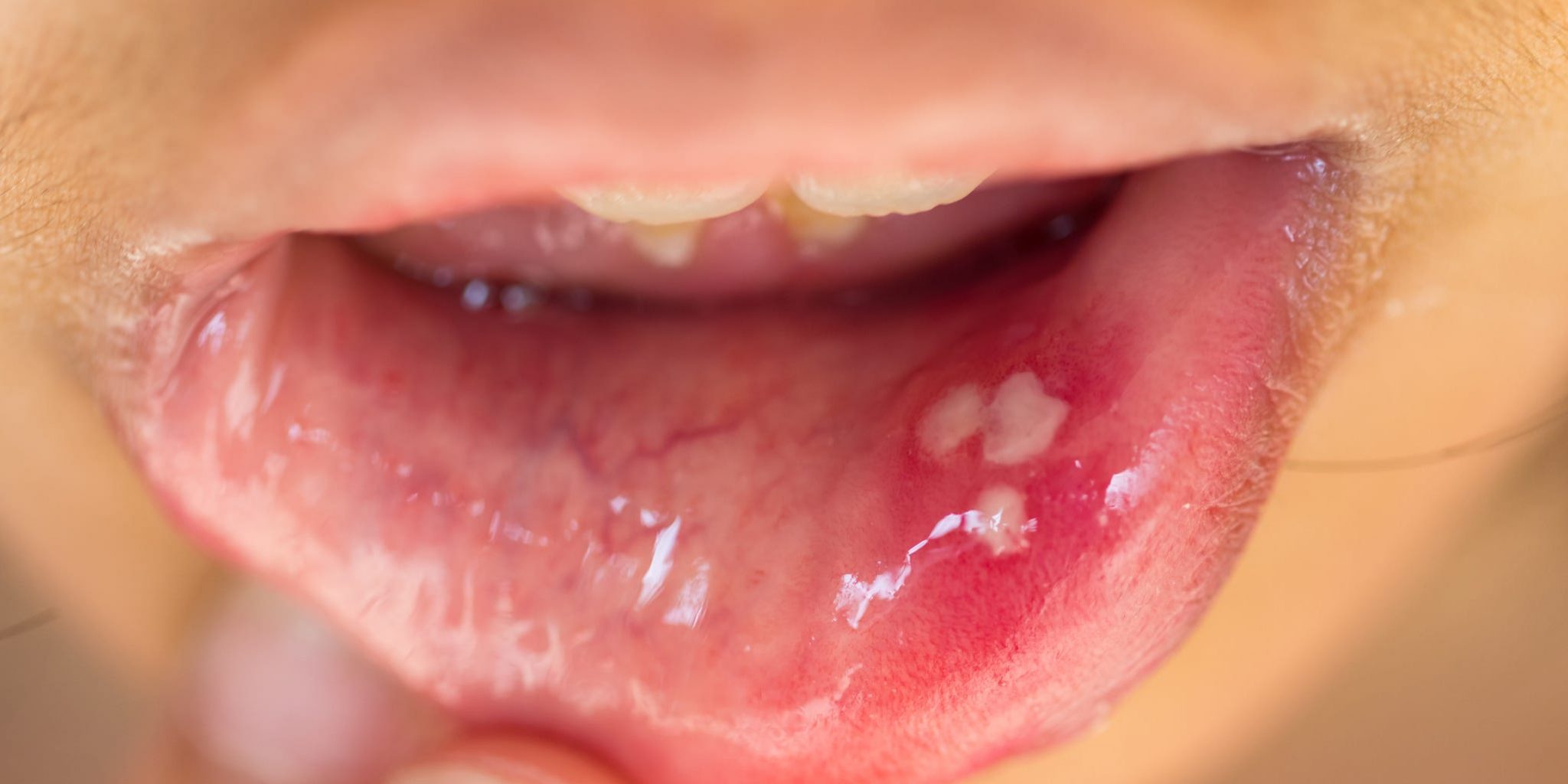 what-are-white-spots-on-gums-and-how-to-prevent-them