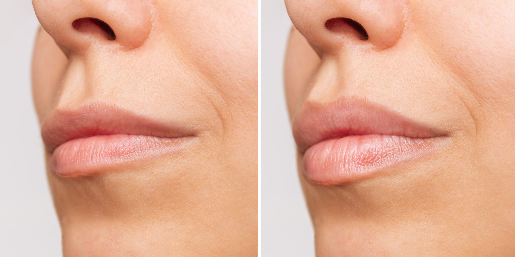 the-stages-of-swelling-after-lip-filler-from-bumpy-to-pouty